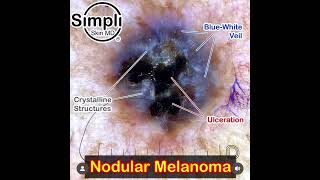 Nodular Melanoma Dermoscopy [upl. by Ahsoem]