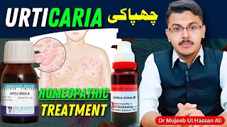 Urtica Urens Homeopathic Medicine Uses  Urticaria  Homeopathic Treatment [upl. by Neerahs]