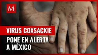 Qué es el coxsackie y cómo se contagia la enfermedad que tiene en alerta a México [upl. by Algernon]