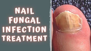 HOW TO TREAT FUNGAL NAIL INFECTION  TINEA UNGUIUM  ONYCHOMYCOSIS [upl. by Washington]