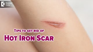 GET RID OF SCARS FROM BURNS  How do I remove a hot iron scar  Dr Nischal K  Doctors Circle [upl. by Anetta140]