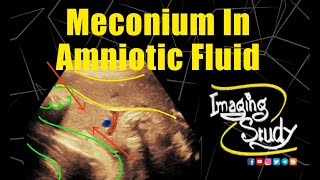 Meconium in Amniotic Fluid  Ultrasound  Case 314 [upl. by Estrin939]