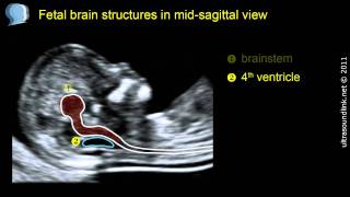 Normal fetal brain anatomy at 1113 weeks  2D scan [upl. by Ardnauq796]