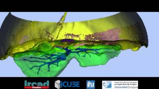 SLAM based Quasi Dense Reconstruction For Minimally Invasive Surgery Scenes  Augumented Reality [upl. by Arrac71]