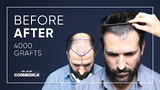 Hair Transplant in Turkey  Results  Dr Acar  Cosmedica Clinic [upl. by Ysdnil332]