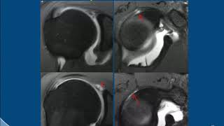 MRI Shoulder Arthrography Interpretation and Variants [upl. by Htebaile480]