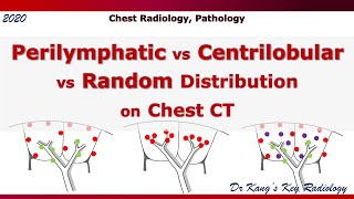 Perilymphatic vs Centrilobular vs Random distribution on Chest CT [upl. by Akselaw758]