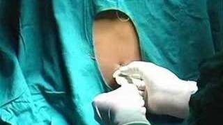 Lumbar Puncture [upl. by Jacey]