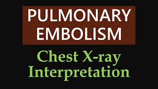 Pulmonary Embolism  Chest Xray Interpretation [upl. by Aynom]