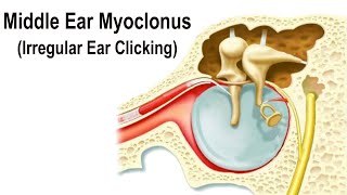 Middle Ear Myoclonus  Irregular Clicking Sound in the Ear [upl. by Celene]