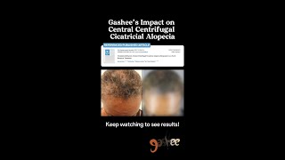 Central Centrifugal Cicatricial Alopecia Improvement Results [upl. by Ik328]