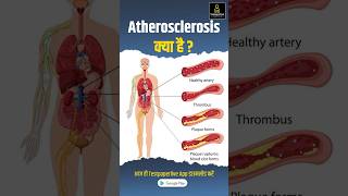 Atherosclerosis के क्या है  Causes sign and symptoms atherosclerosis testpaperlive shorts [upl. by Kellie]