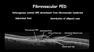 Clinical changes in RPE course  PED in AMD [upl. by Yrbua]