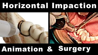 My Technique for Horizontal Impacted Mandibular Third Molar Extraction [upl. by Niasuh217]