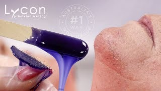 Goodbye Pesky Chin Hairs With LYCOJET Lavender Hot Wax  LYCON Cosmetics [upl. by Illehs]