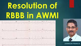 Resolution of RBBB in AWMI [upl. by Helbonnas]