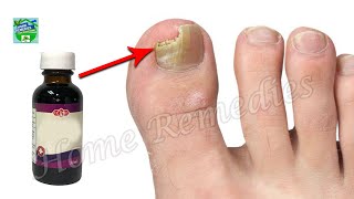 A Miraculous Method That Destroys Foot And Nail Fungus [upl. by Gable]