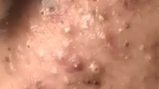 Huge Acne Pimples Blackheads Popping Up Satisfying with Oddly Calm Music [upl. by Athiste]