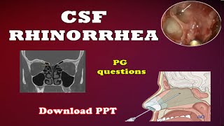 CSF RHINORRHEA  ENT  Easy explanation  All you need to know [upl. by Hazlett780]