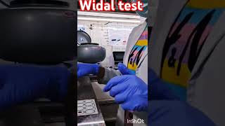 Widal test typhoid  medical 🧪🧪 [upl. by Napoleon]