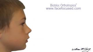 Dr Hangs Biobloc Orthotropic ® Treatment  Morph [upl. by Thayer]