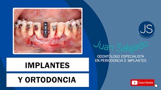 Implantes y Ortodoncia Odontologia Practica [upl. by Oemac]