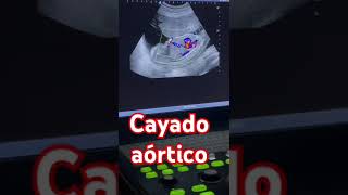 Cayado aórtico [upl. by Artemla]