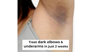 Dark Neck amp Underarms Treatment  Treat Acanthosis Nigricans [upl. by Blane]