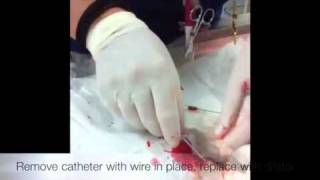 Placing a jugular catheter [upl. by Bonns]