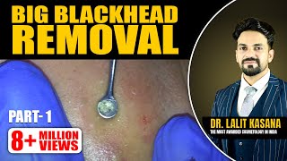 BIG BLACKHEAD REMOVAL Part 1 [upl. by Dawaj491]