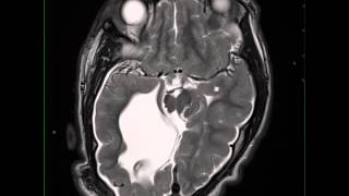 Callosal Dysgenesis Cortical Gray Matter Heterotopia and Small Posterior Cranial Fossa NO [upl. by Auahsoj617]