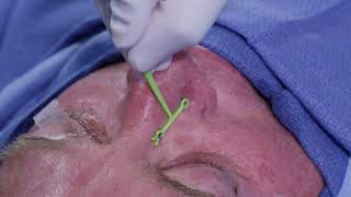 Demonstration of the Latera Implant for Nasal Valve Collapse Warning Graphic Surgical Content [upl. by Cirdnek587]