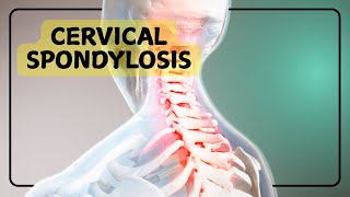 Cervical Spondylosis [upl. by Tamar]