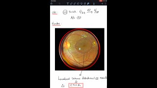 Case 10 Central Serous Chorio Retinopathy CSCR  A complete review [upl. by Martelli]