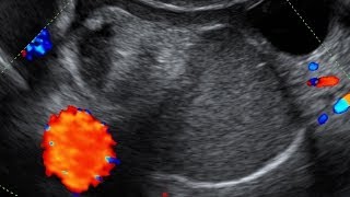 Ovarian Dermoid Cyst on Transvaginal Ultrasound [upl. by Eycats]