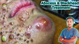 Abscess Treatment Causes Symptoms and Removalquot [upl. by Gibby]