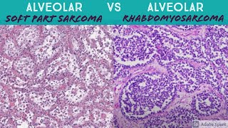 Alveolar Soft Part Sarcoma vs Alveolar Rhabdomyosarcoma [upl. by Tonnie416]