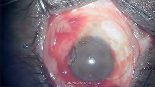 Pterygium excision with autograft By Dr K L Agrawal [upl. by Ilzel]