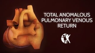 Total Anomalous Pulmonary Venous Return [upl. by Auston]