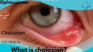 What is chalazion  what causedchalazion  Is chalazion a stye [upl. by Eire]