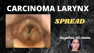 088Spread of Cancer Larynx  Part 12 carcinoma larynx [upl. by Alam]