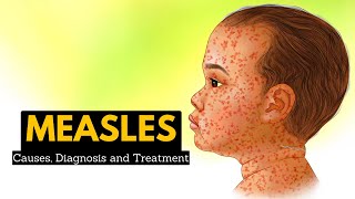 Measles Causes Signs and Symptoms Diagnosis and Treatment [upl. by Fuhrman]