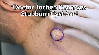 Entire Cyst Sac Removed from Patients Back  CONTOUR DERMATOLOGY [upl. by Nylsor]