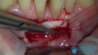 Innesto gengivale libero  free gingival graft [upl. by Mat]