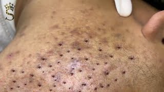 Big Cystic Acne Blackheads Extraction Blackheads amp Milia Whiteheads Removal Pimple Popping  3906 [upl. by Aleetha65]