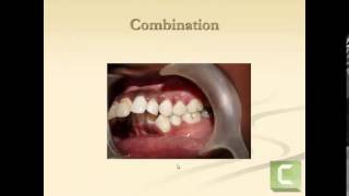 Classification of malocclusion [upl. by Ahsenav]