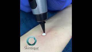 Cryopen Blemish Removal Treatment  Skintique Clinic [upl. by Jobyna755]