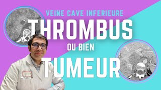 Thrombus ou Tumeur  La VEINE CAVE INFERIEURE en deux scanners démonstratifs [upl. by Friedman772]