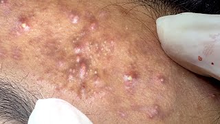 SJ 634 Great Extraction Blackheads And Inflamed Acne [upl. by Amund]