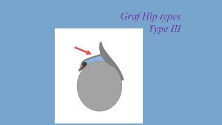 How to interpret the infant hip ultrasound [upl. by Irot616]